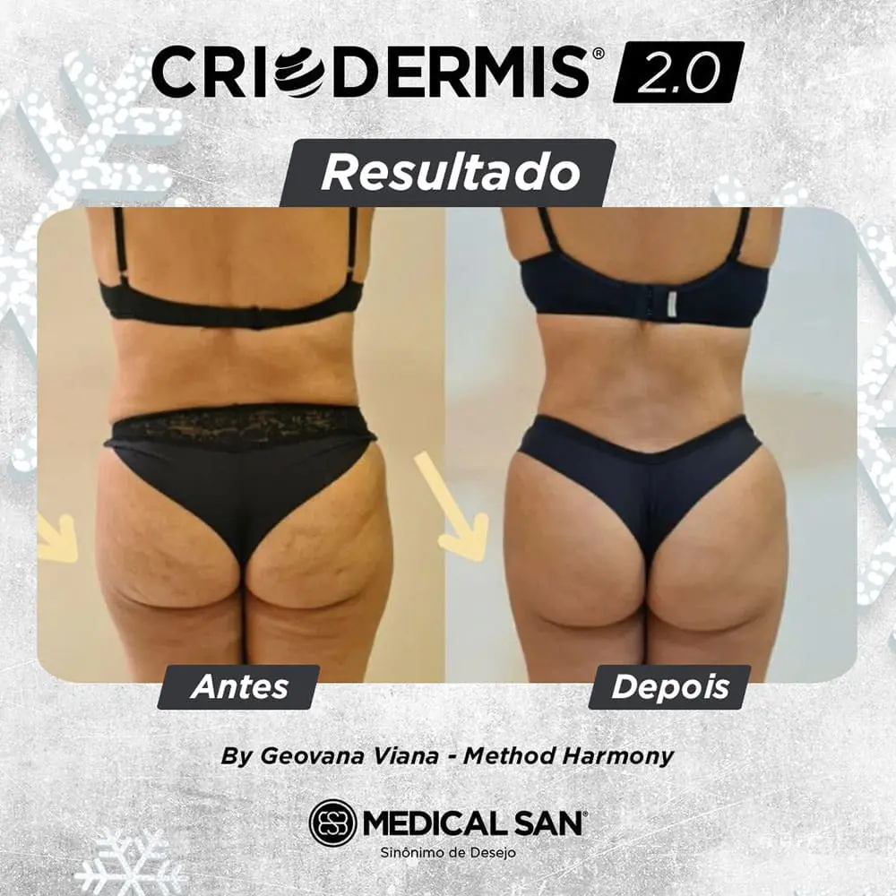 Antes e depois do criodermis 2.0