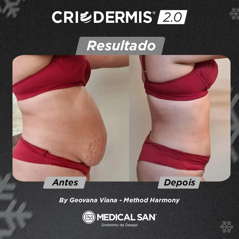 Imagem lateral de modelo feminino tratamento criodermis 2.0