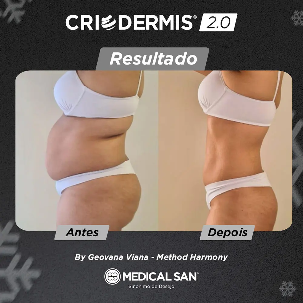 Antes e depois do procedimento de Crio Medical San