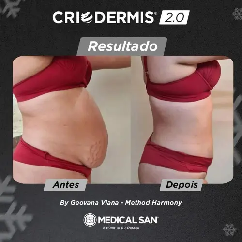 Novo Criodermis 2.0 com 4 Aplicadores G e 2 Aplicadores M + Promoção Aparelho Lipocavity - Medical San