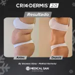 Equipamento De Criolipólise Criodermis 2.0 - Medical San