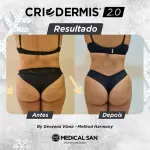 Equipamento De Criolipólise Criodermis 2.0 - Medical San