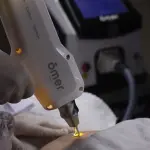 Ômer Smart Laser De Despigmentação Tatuagem e Micropigmentação - Medical San