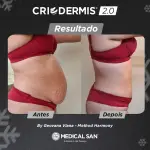 Novo Criodermis 2.0 Com 2 Aplicadores Borda Infinita M e G - Medical San