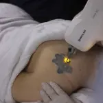 Ômer Smart Laser De Despigmentação Tatuagem e Micropigmentação - Medical San