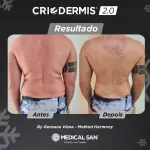 Equipamento De Criolipólise Criodermis 2.0 - Medical San