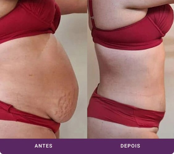 Mulher antes e depois tratamento com Criodermis - visão de perfil