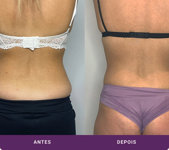 Mulher antes e depois tratamento com Criodermis - visão de costas