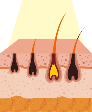 Imagem representando camada de pele com 4 pelos sendo danificados com o calor elevado