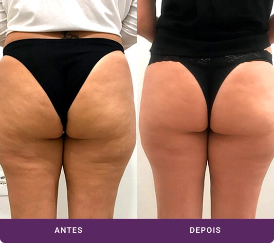 Exemplo de tratamento de Culote