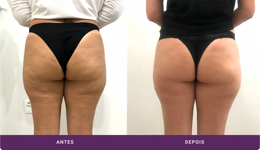 Exemplo de tratamento de Culote