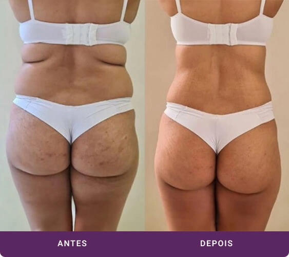 Mulher antes e depois tratamento com Criodermis - visão dos glúteos